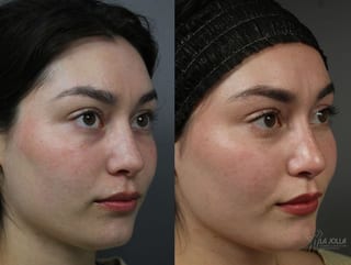 Before and after PRP Liquid Facelift case 36443 - Angle 2