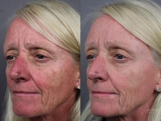 Before and after IPL case 36444 - Angle 1