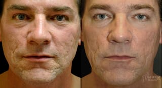 Before and after Acne: Laser Treatment case 36445 - Angle 1