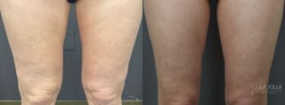Before and after Thermage case 36159 - Angle 1