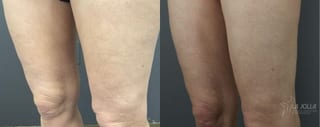 Before and after Thermage case 36159 - Angle 2