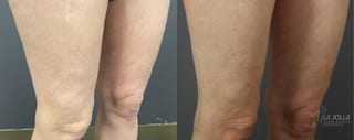 Before and after Thermage case 36159 - Angle 3