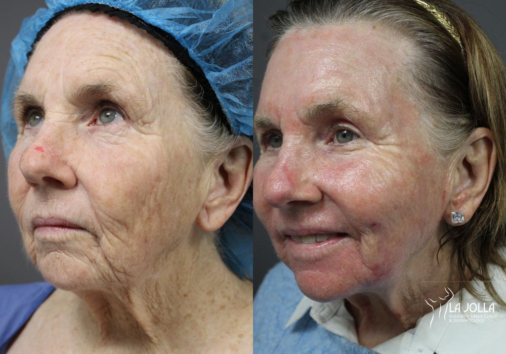 Before photo - Angle 3