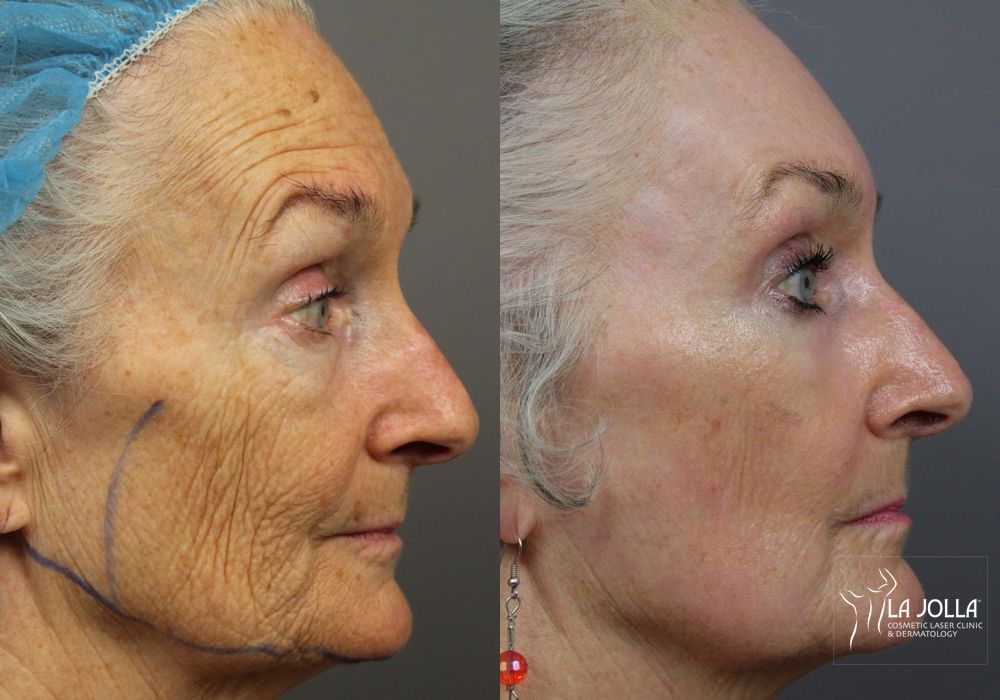 Before photo - Angle 5