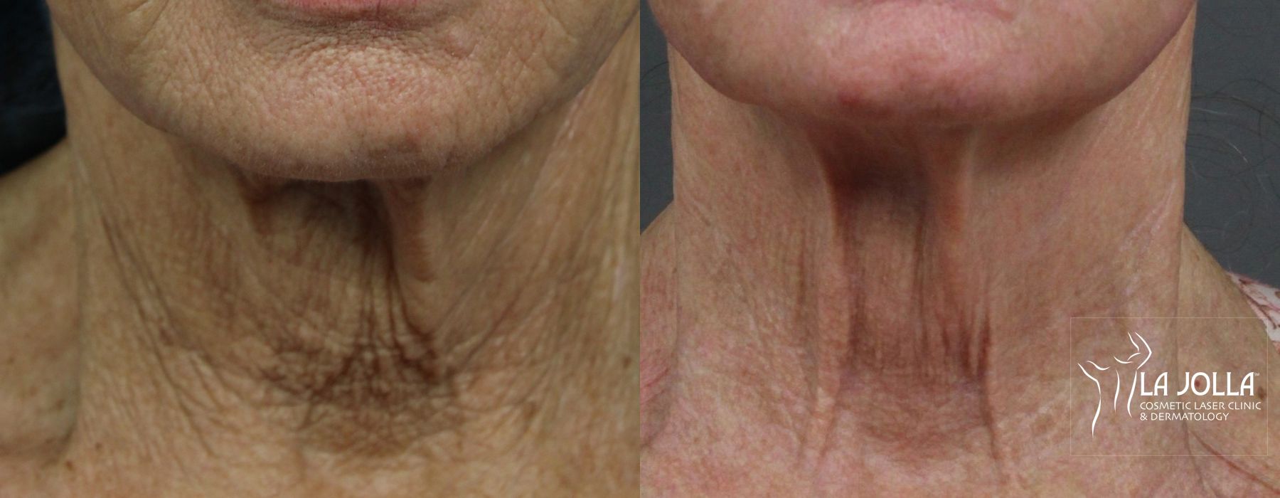 Before photo - Angle 4