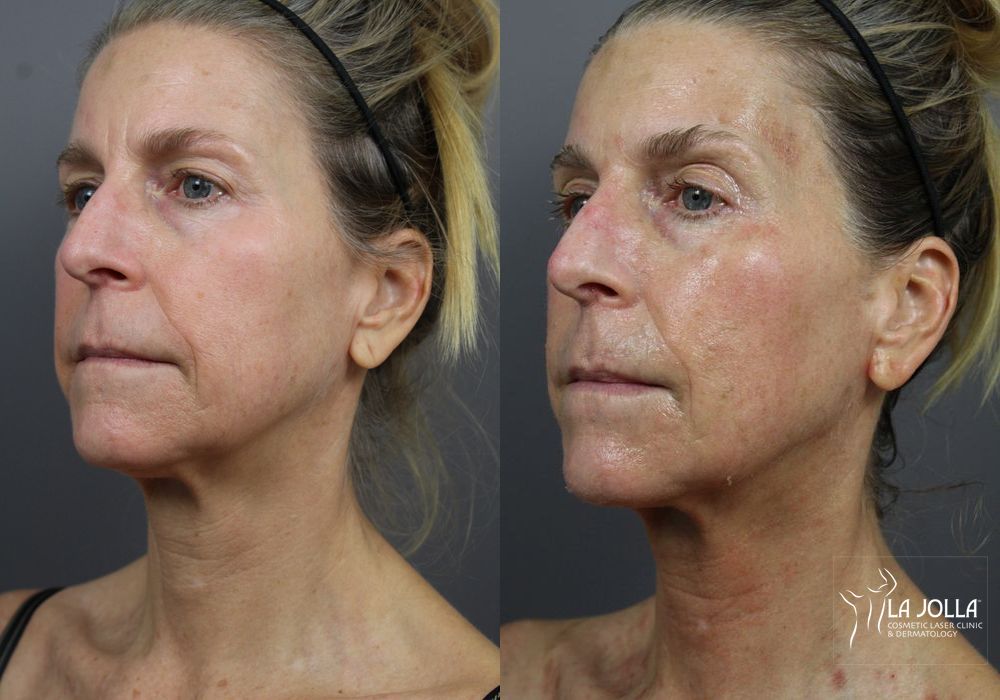 Before photo - Angle 3