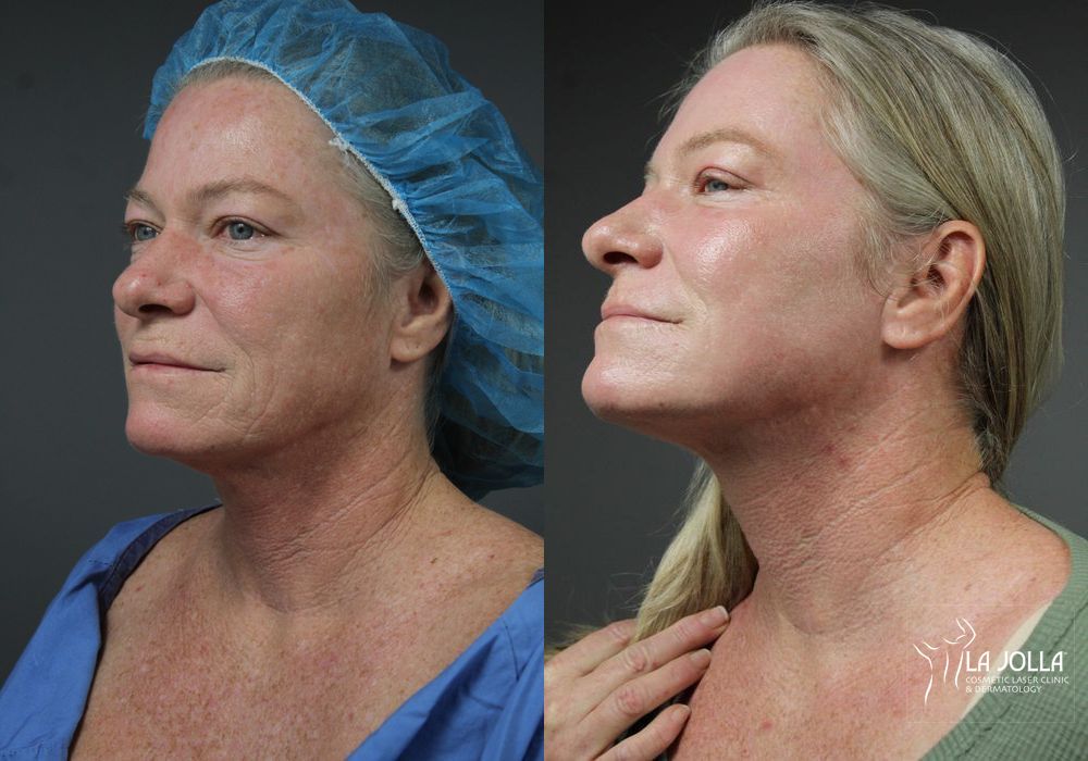 Before photo - Angle 3