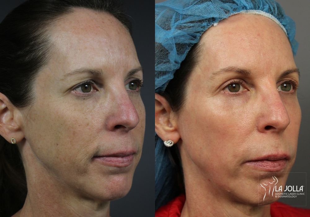 Before photo - Angle 2