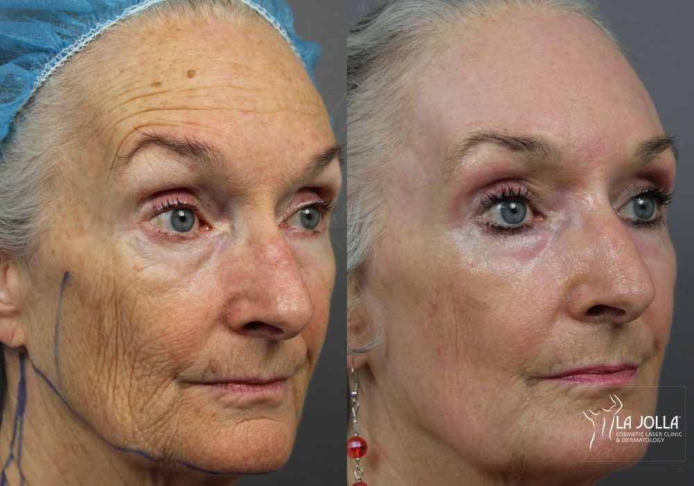 Before photo - Angle 4