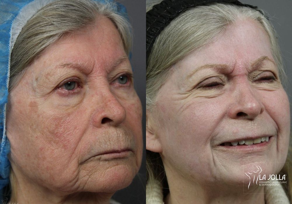 Before photo - Angle 3