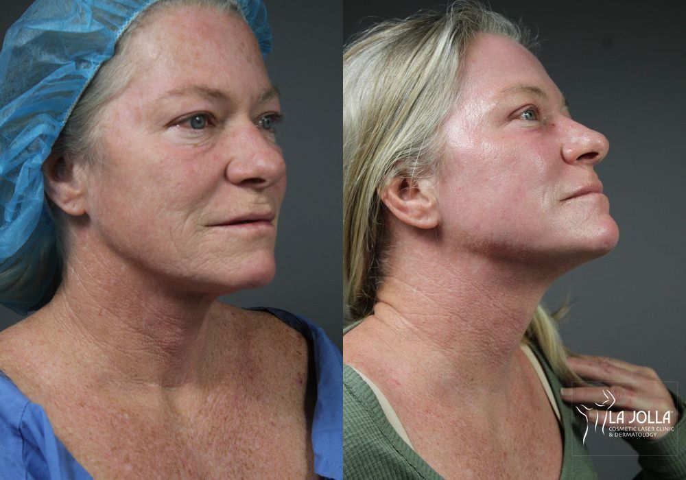 Before photo - Angle 2