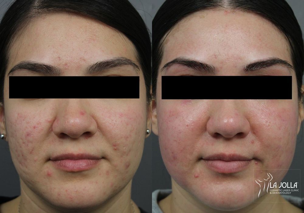 Before photo - Angle 2