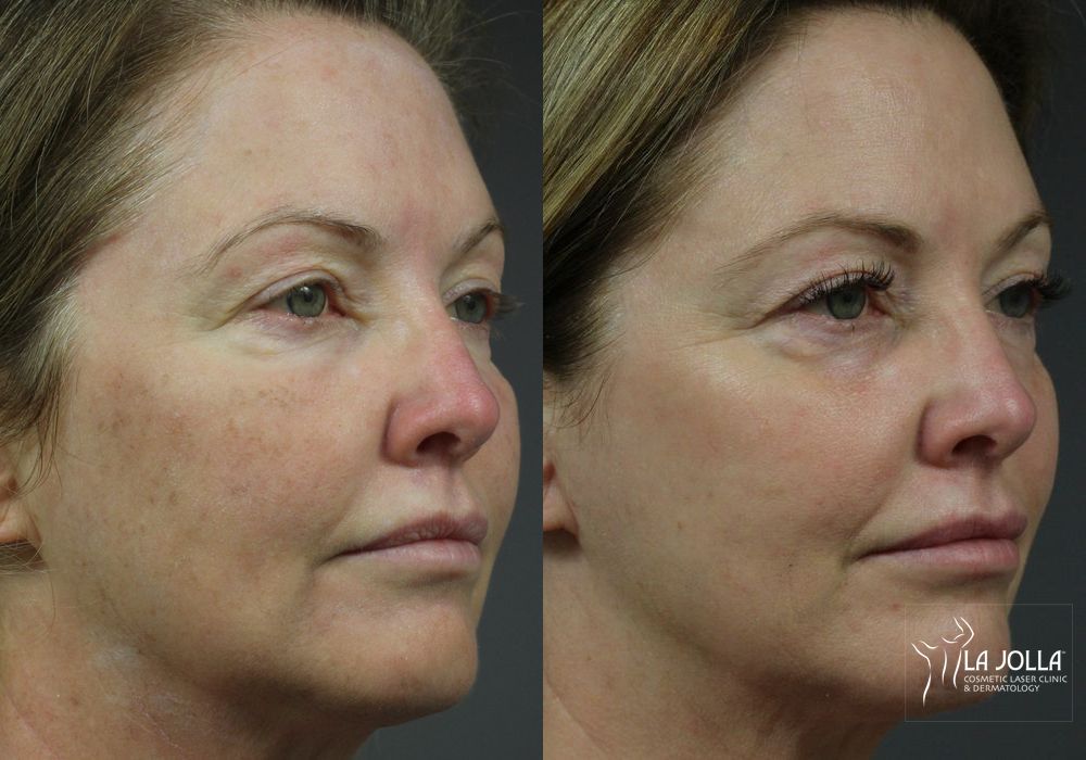 Before photo - Angle 2