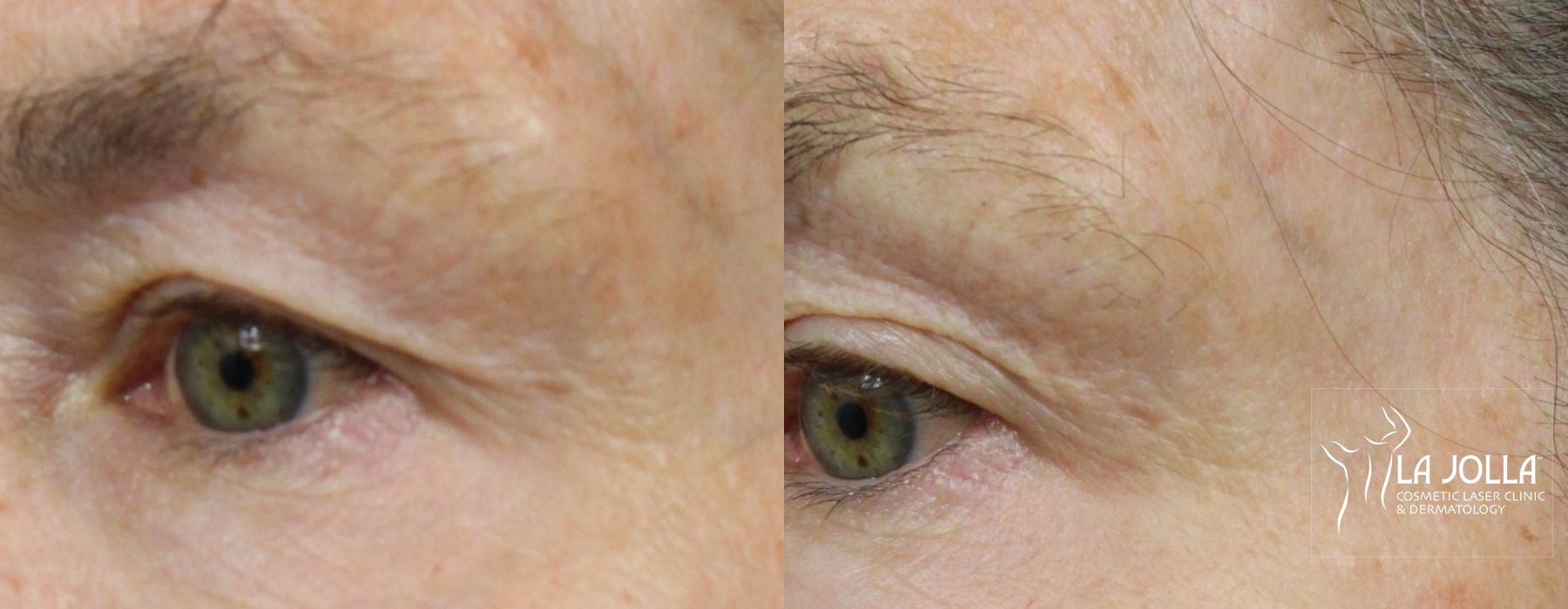 Before and after 6D Platinum Laser Lift case 36438