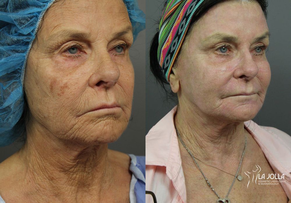 Before photo - Angle 2