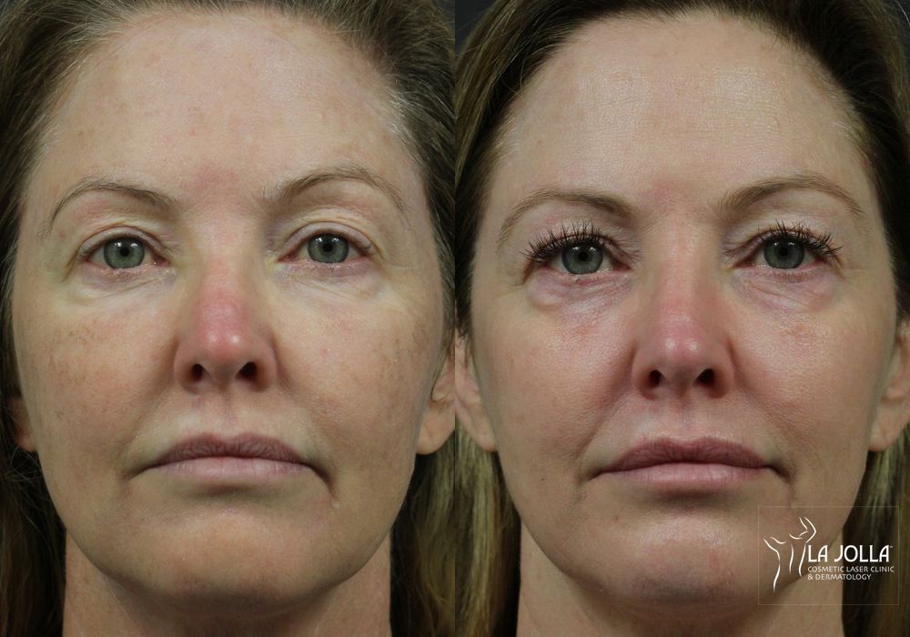 Before photo - Angle 3