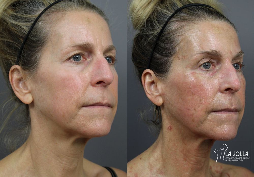 Before photo - Angle 2