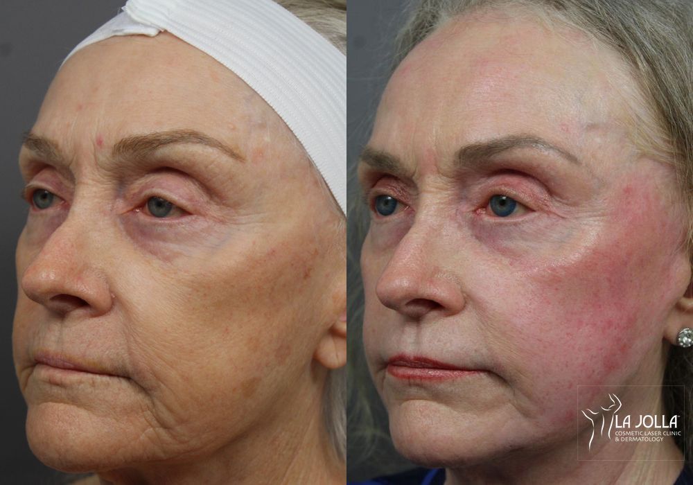 Before photo - Angle 2