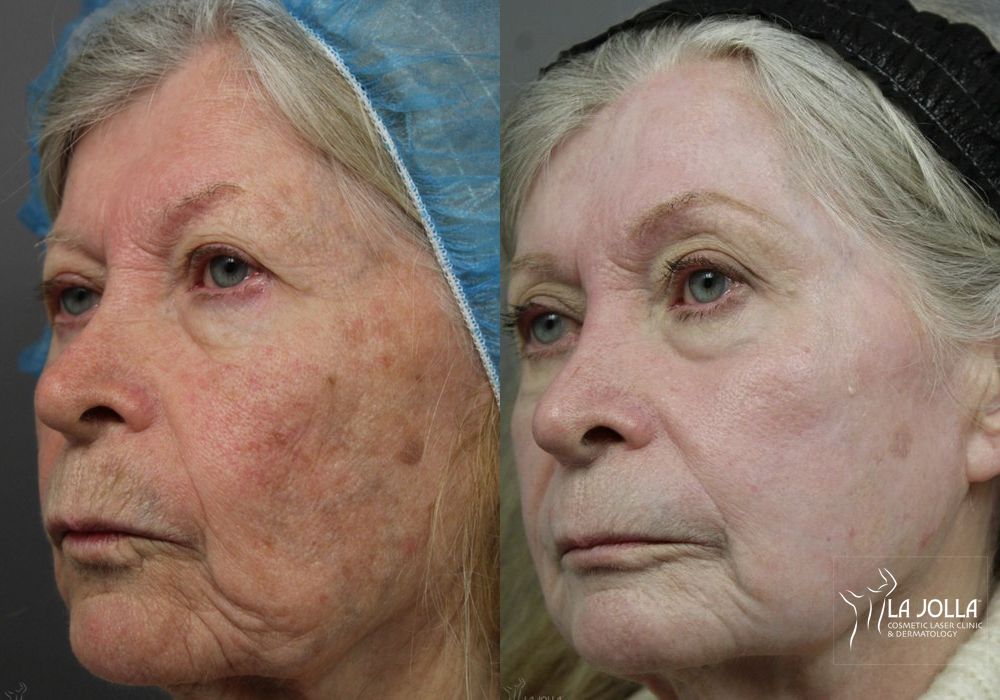 Before photo - Angle 2