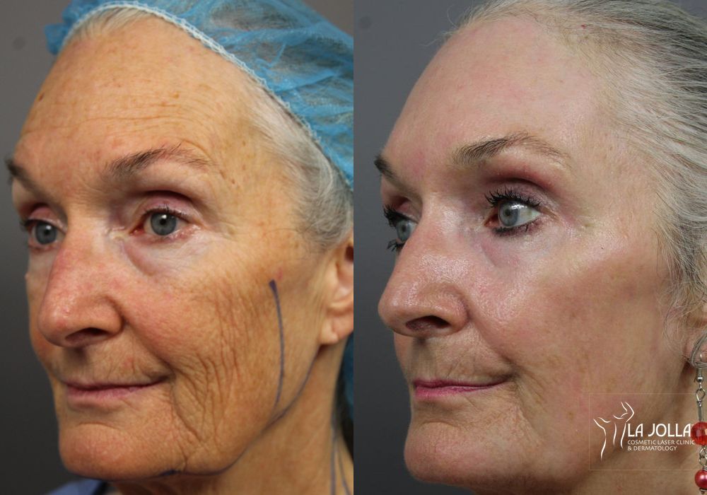 Before photo - Angle 2