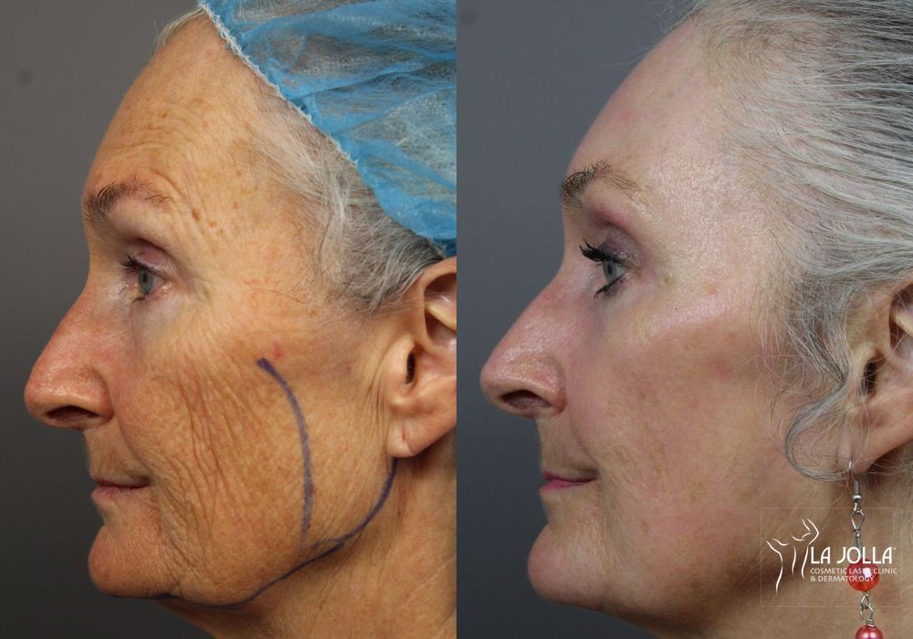 Before photo - Angle 3