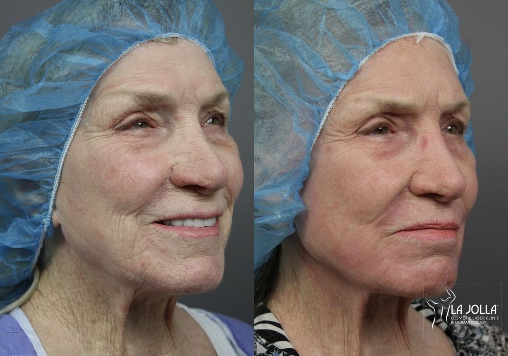 Before photo - Angle 3