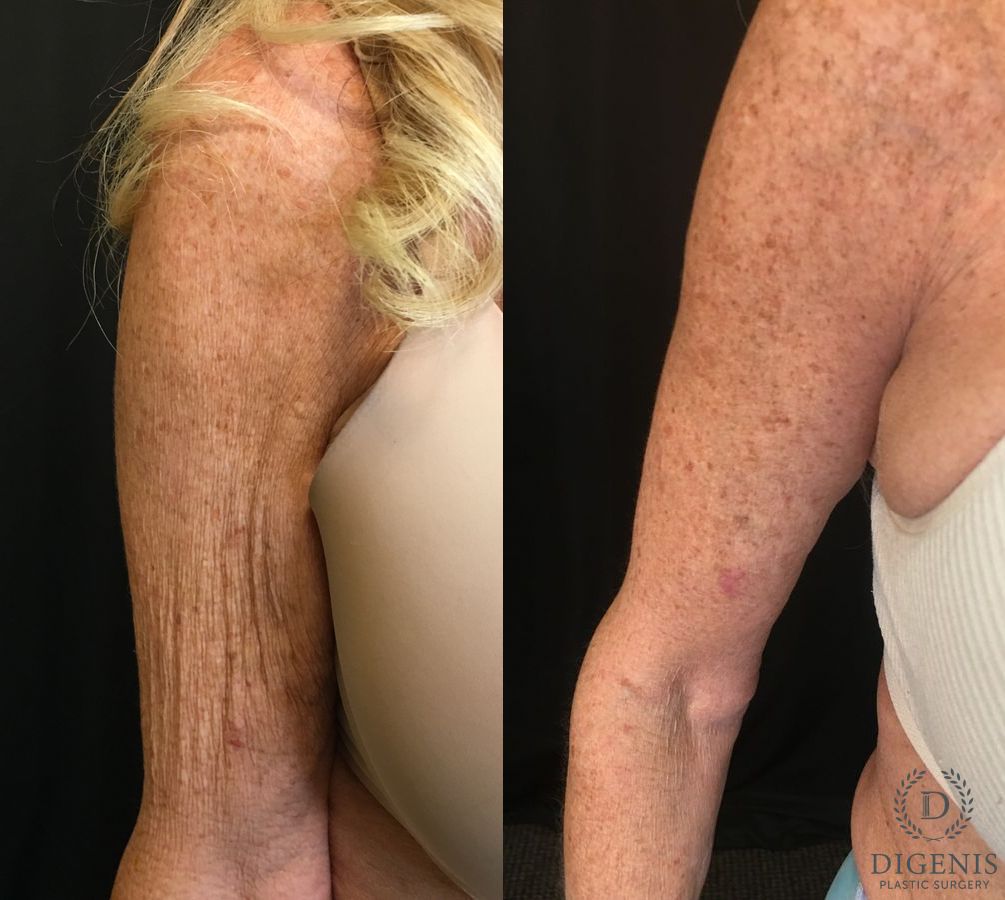 Before and after Arm Lift case 35061 - Angle 3
