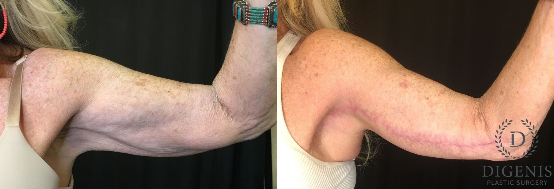 Before and after Arm Lift case 35061