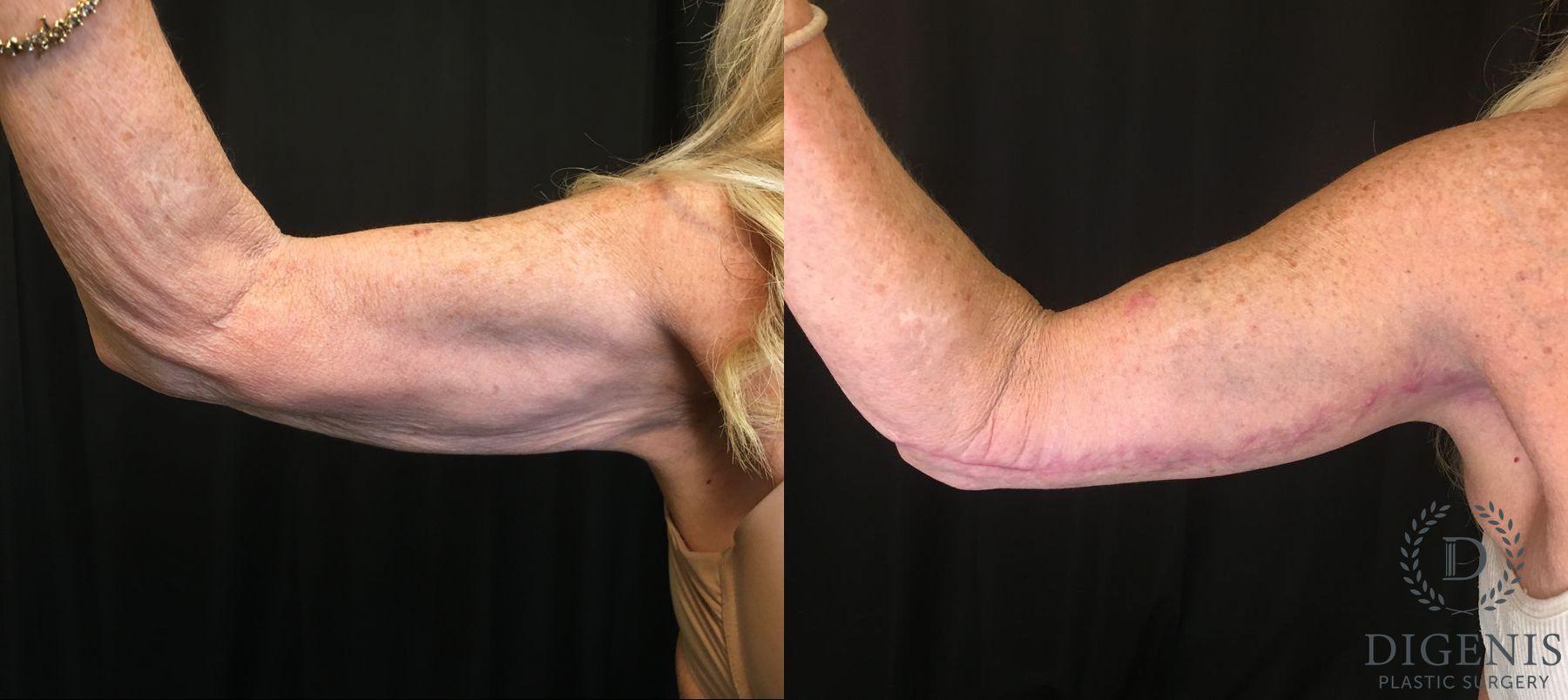 Before and after Arm Lift case 35061 - Angle 2