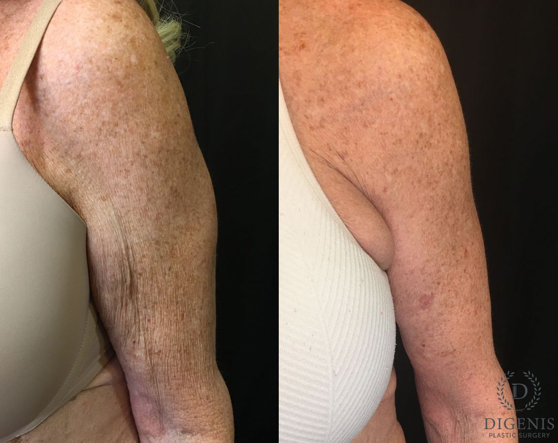 Before and after Arm Lift case 35061 - Angle 4