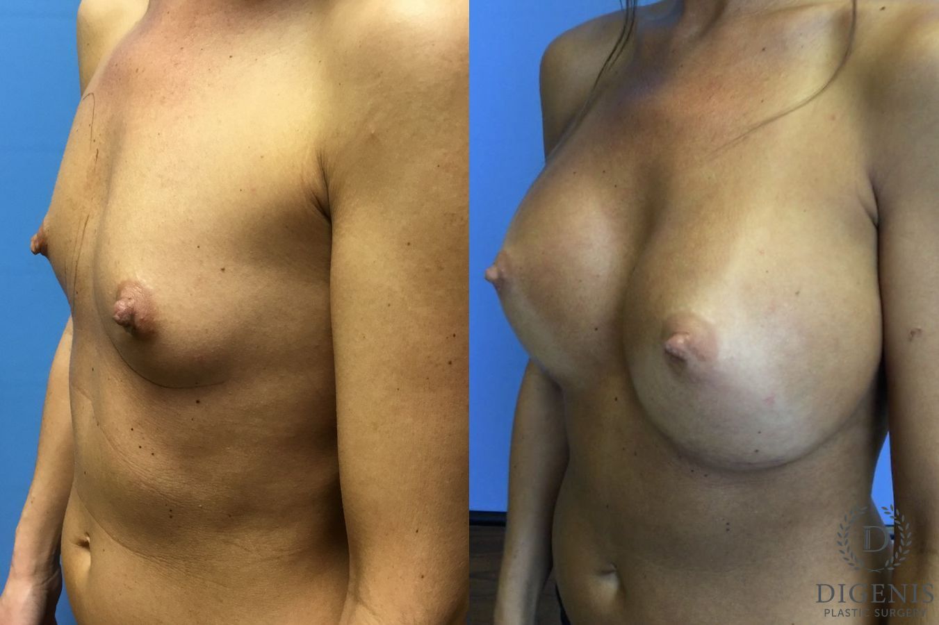 Before and after Breast Augmentation case 35110 - Angle 4
