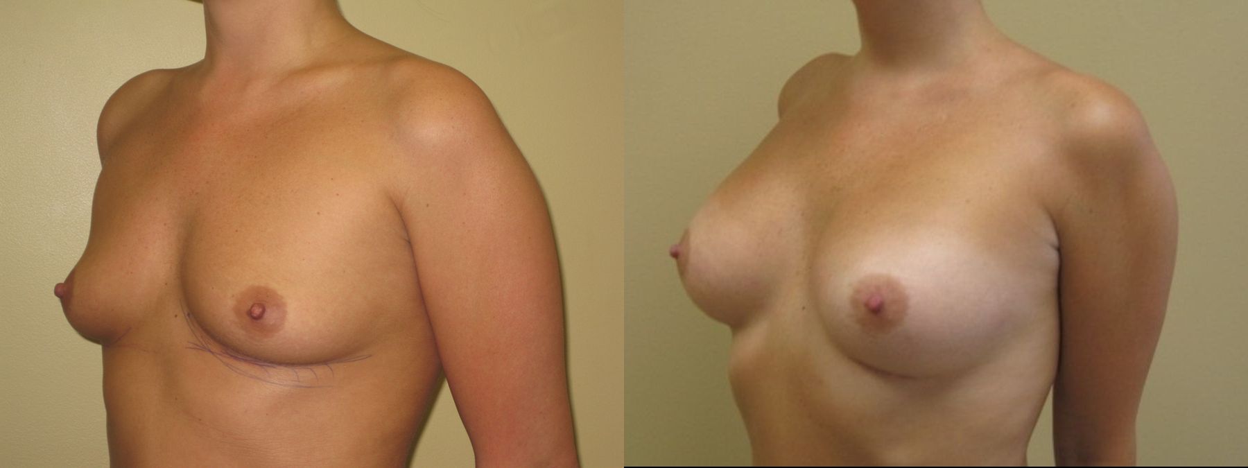 Before and after Breast Augmentation case 35081 - Angle 3