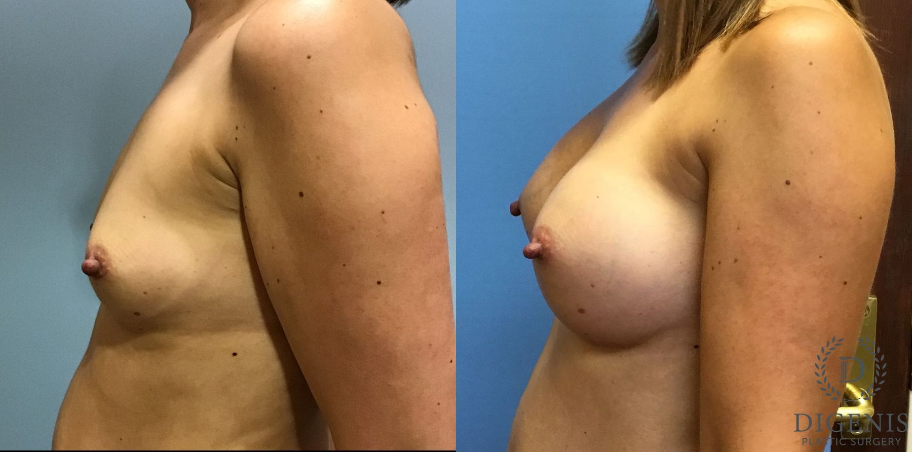 Before and after Breast Augmentation case 35113 - Angle 5