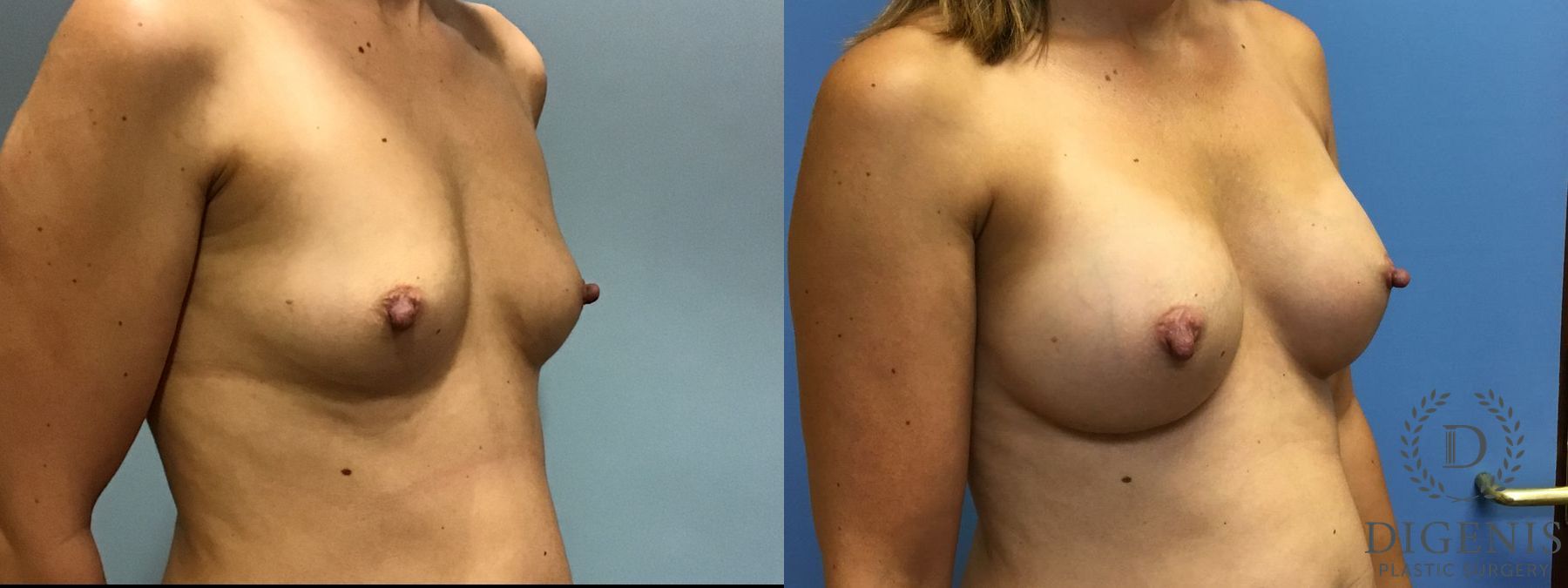 Before and after Breast Augmentation case 35113 - Angle 2