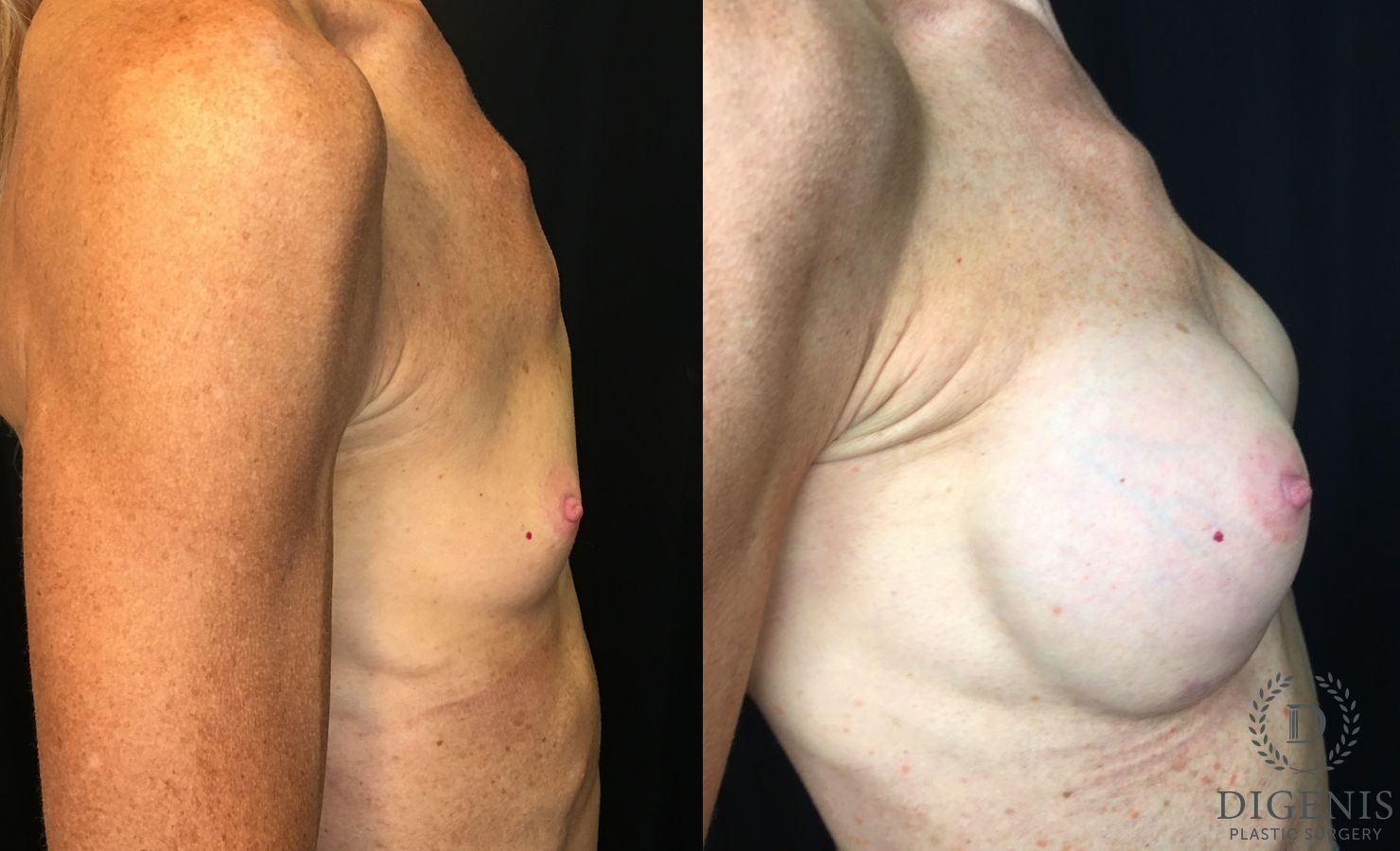 Before and after Breast Augmentation case 35172 - Angle 3