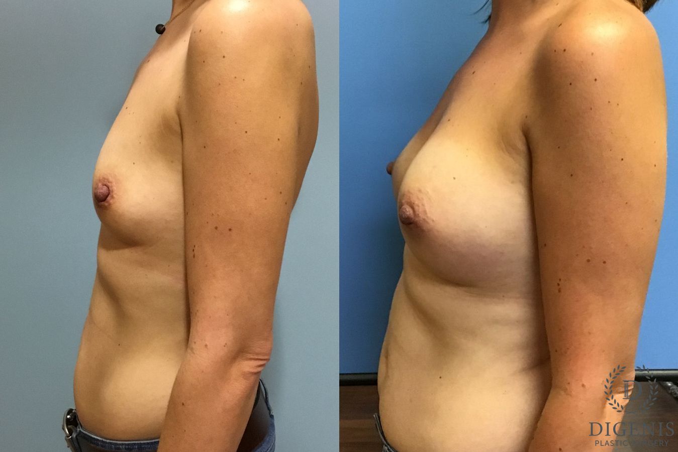 Before and after Breast Augmentation case 35115 - Angle 5
