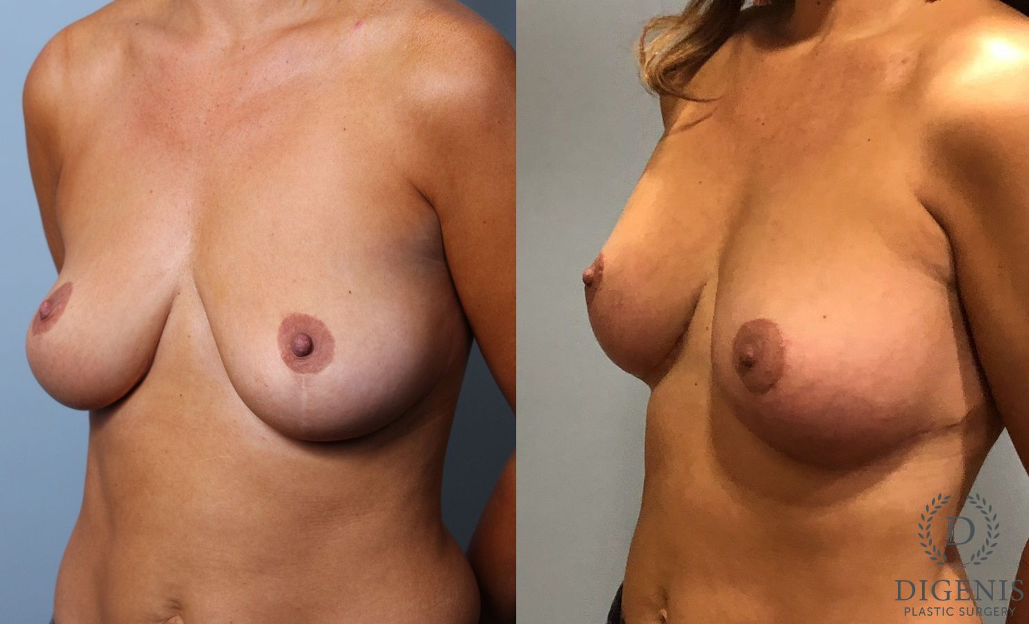 Before and after Breast Augmentation case 35116 - Angle 4