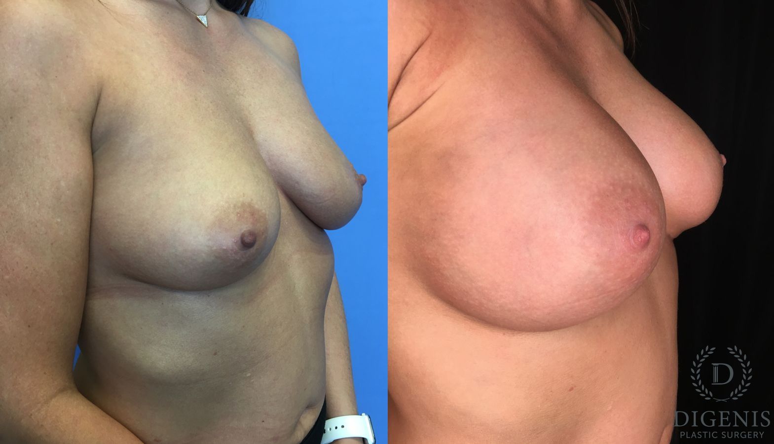 Before and after Breast Augmentation case 35176 - Angle 2