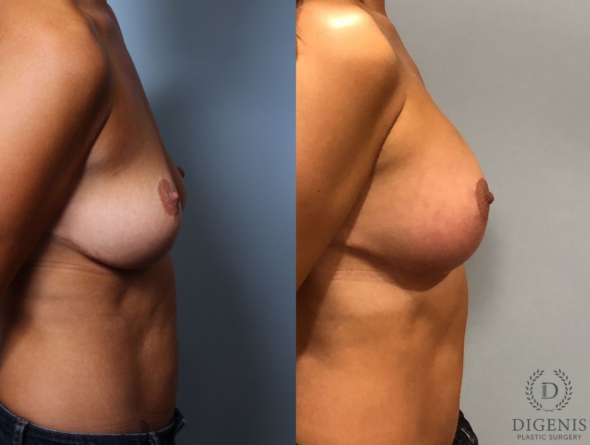 Before and after Breast Augmentation case 35116 - Angle 3