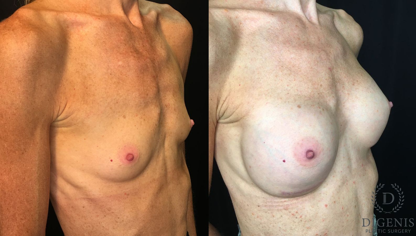Before and after Breast Augmentation case 35172 - Angle 2