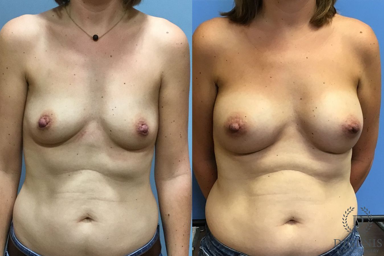 Before and after Breast Augmentation case 35115