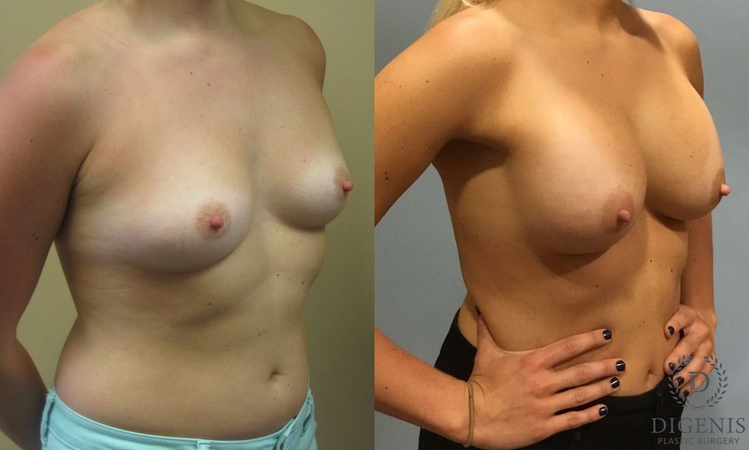 Before and after Breast Augmentation case 35091 - Angle 2