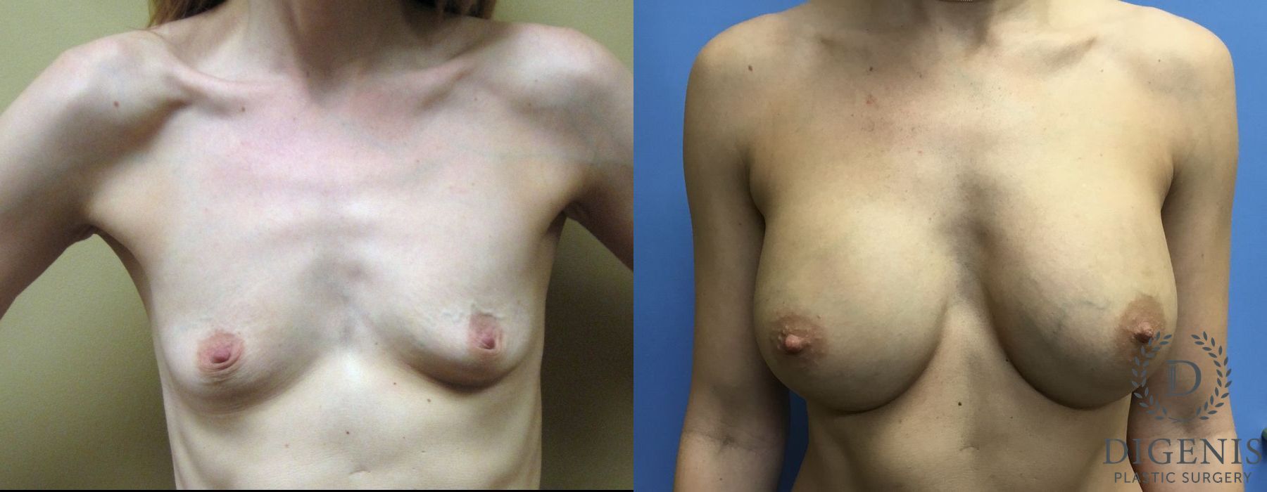 Before and after Breast Augmentation case 35041