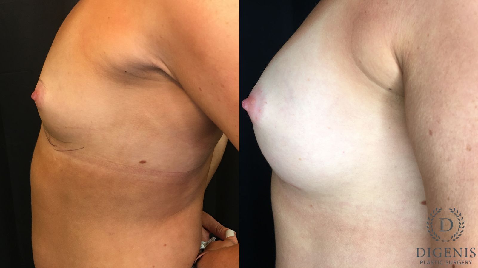 Before and after Breast Augmentation case 35166 - Angle 5