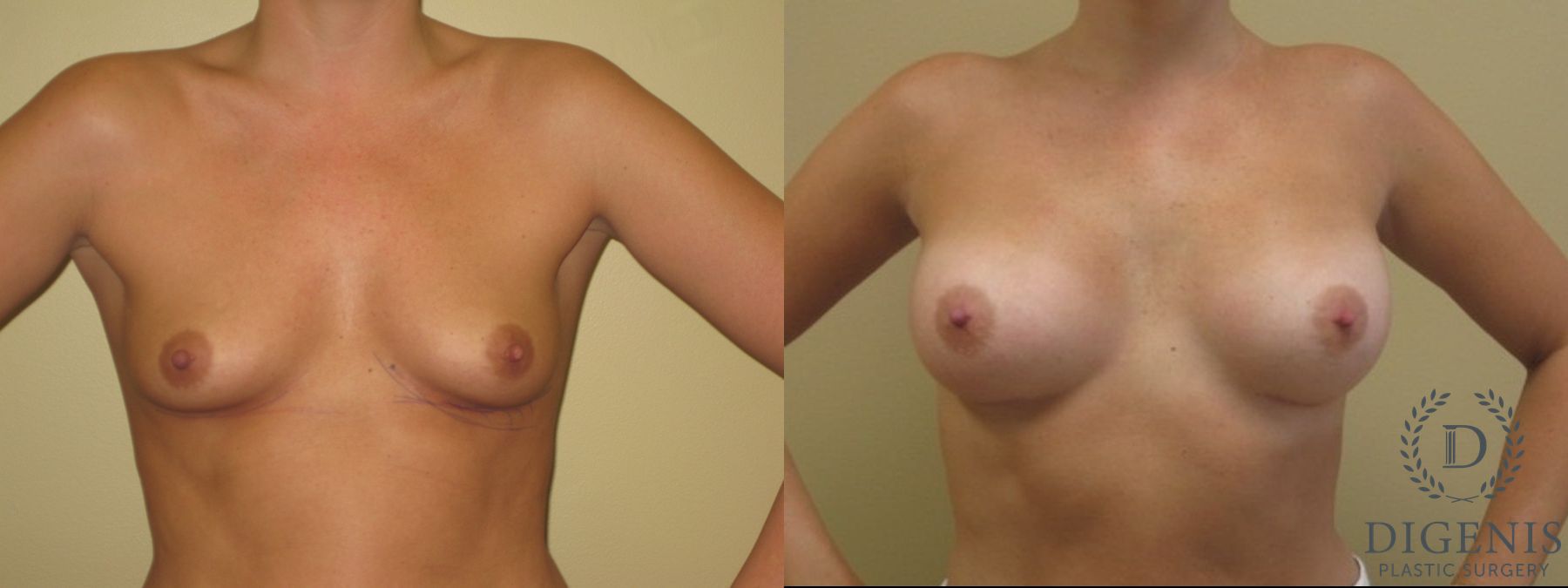Before and after Breast Augmentation case 35081