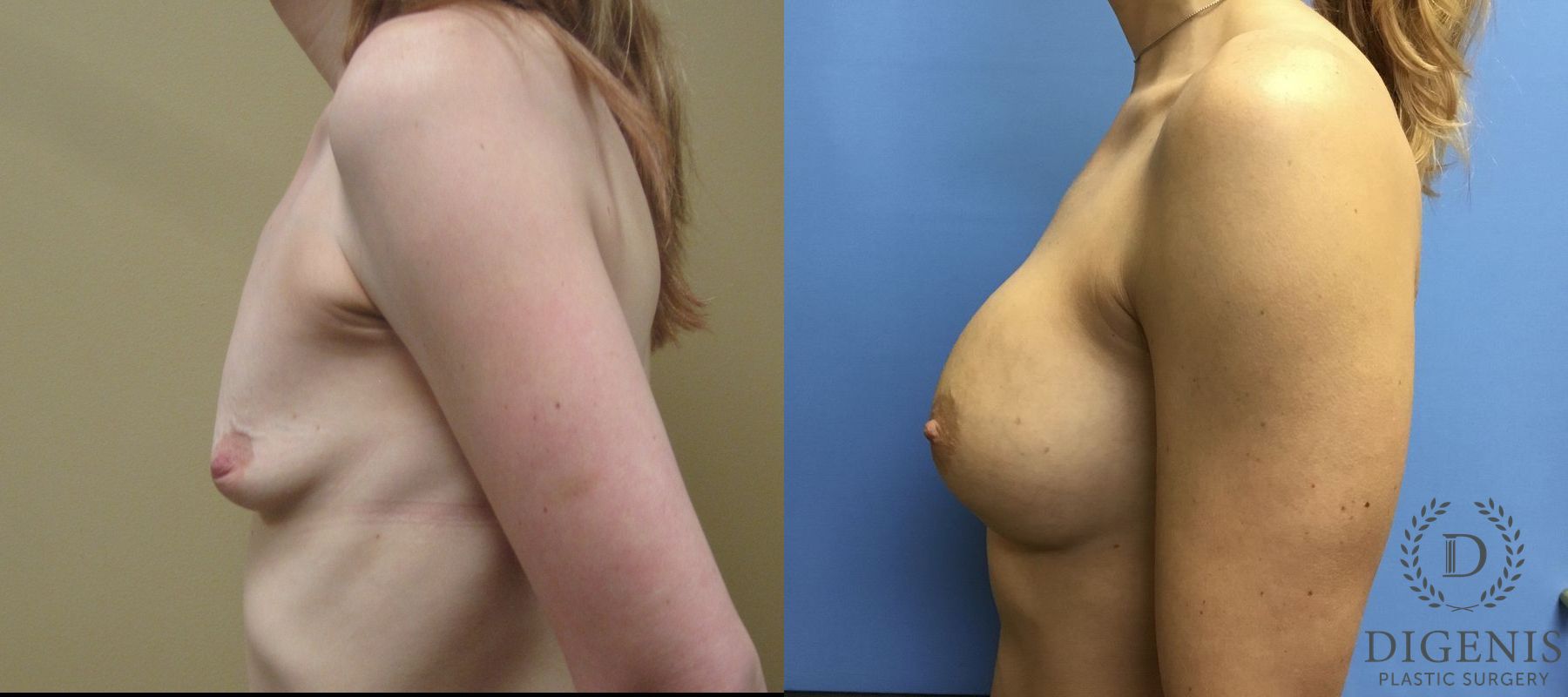Before and after Breast Augmentation case 35041 - Angle 5