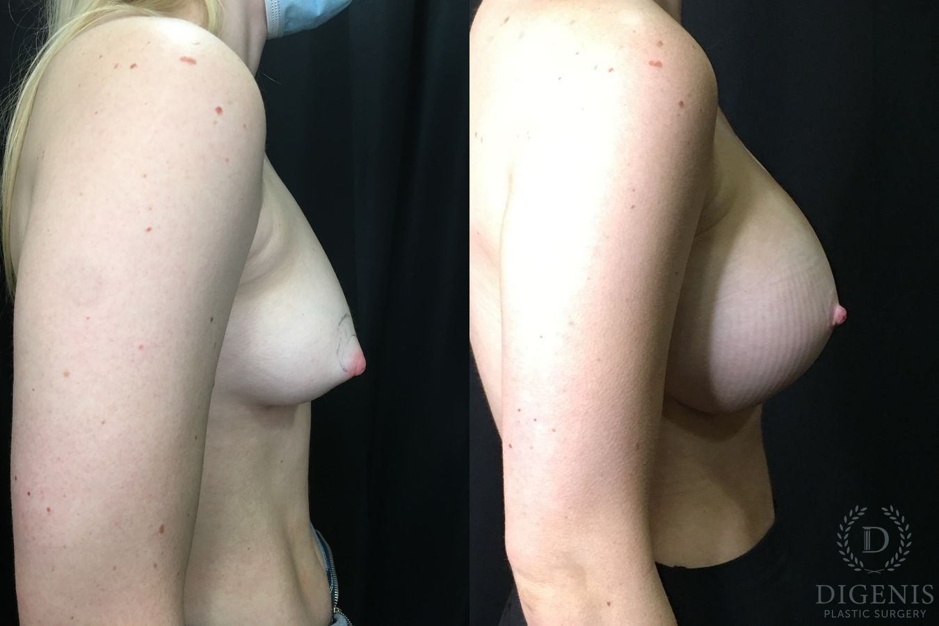 Before and after Breast Augmentation case 35177 - Angle 3