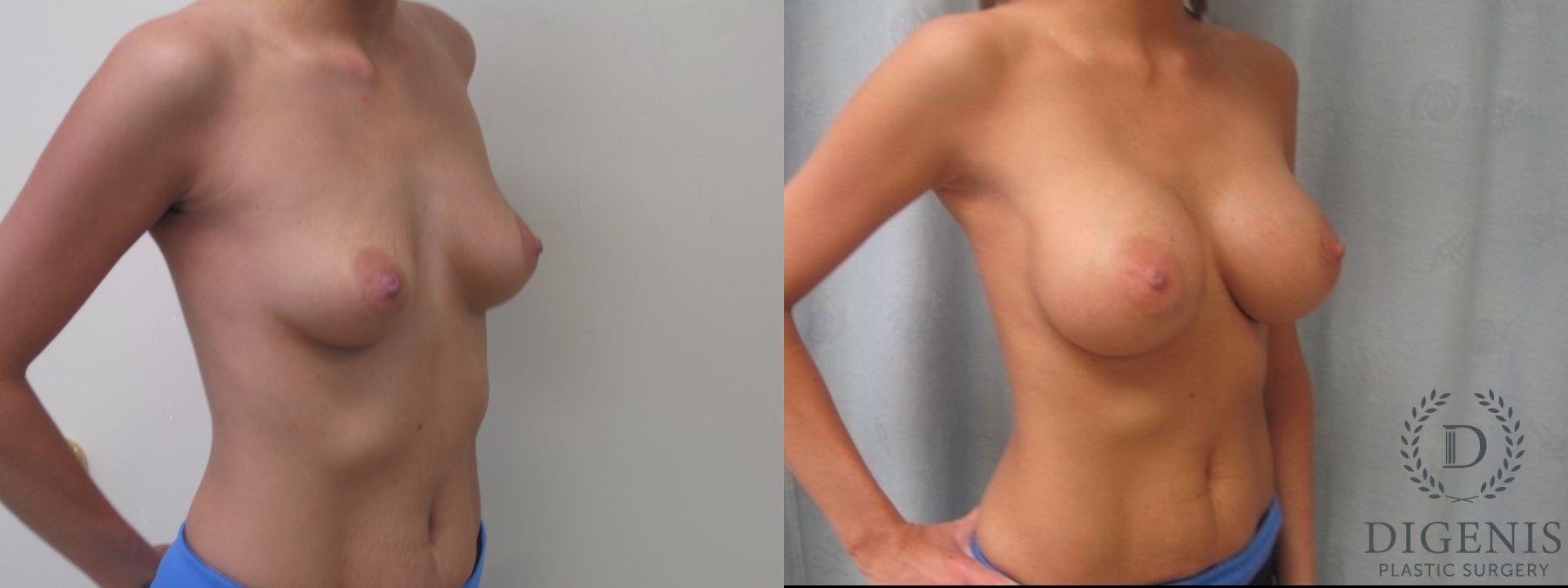 Before and after Breast Augmentation case 35087 - Angle 4