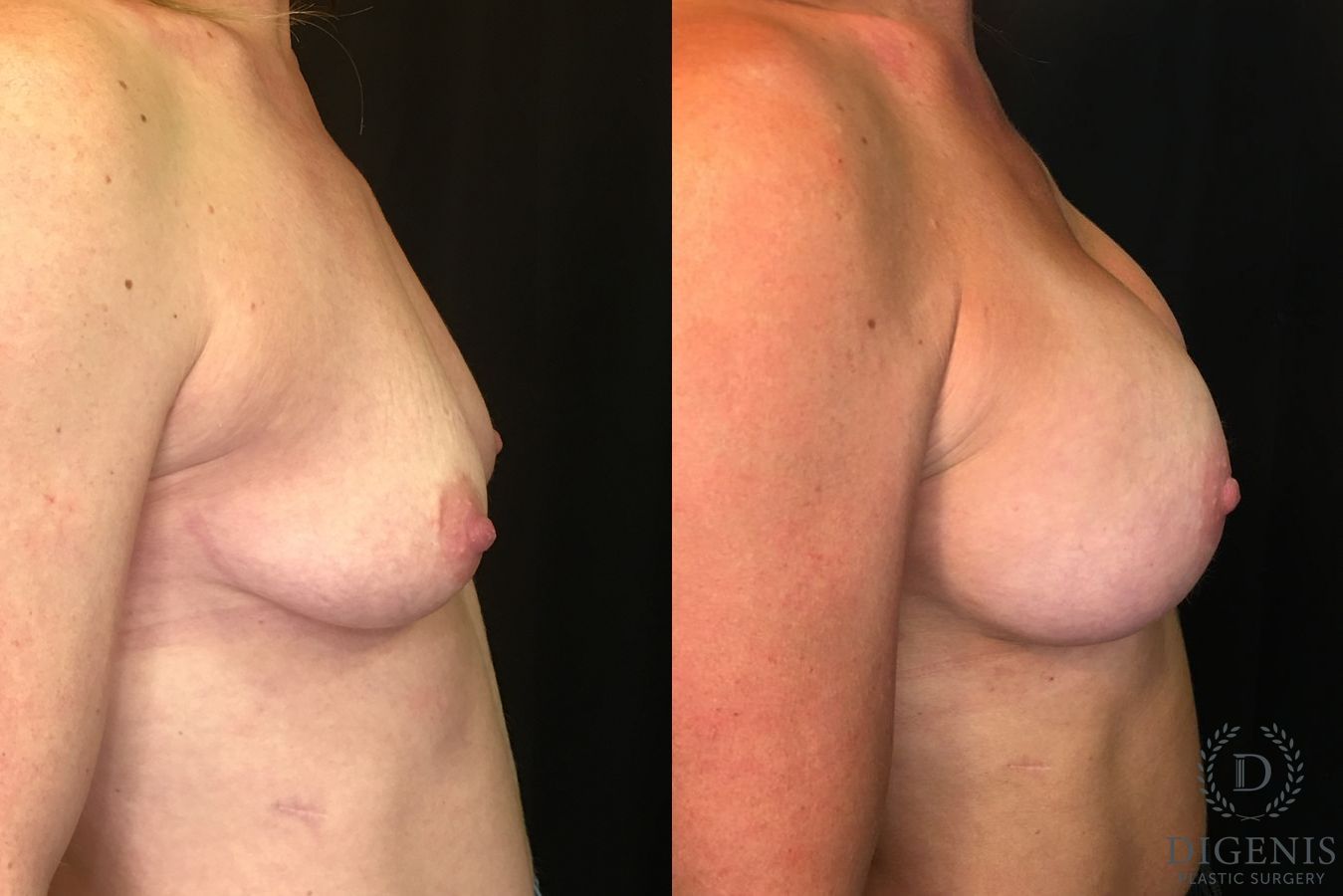 Before and after Breast Augmentation case 35136 - Angle 3