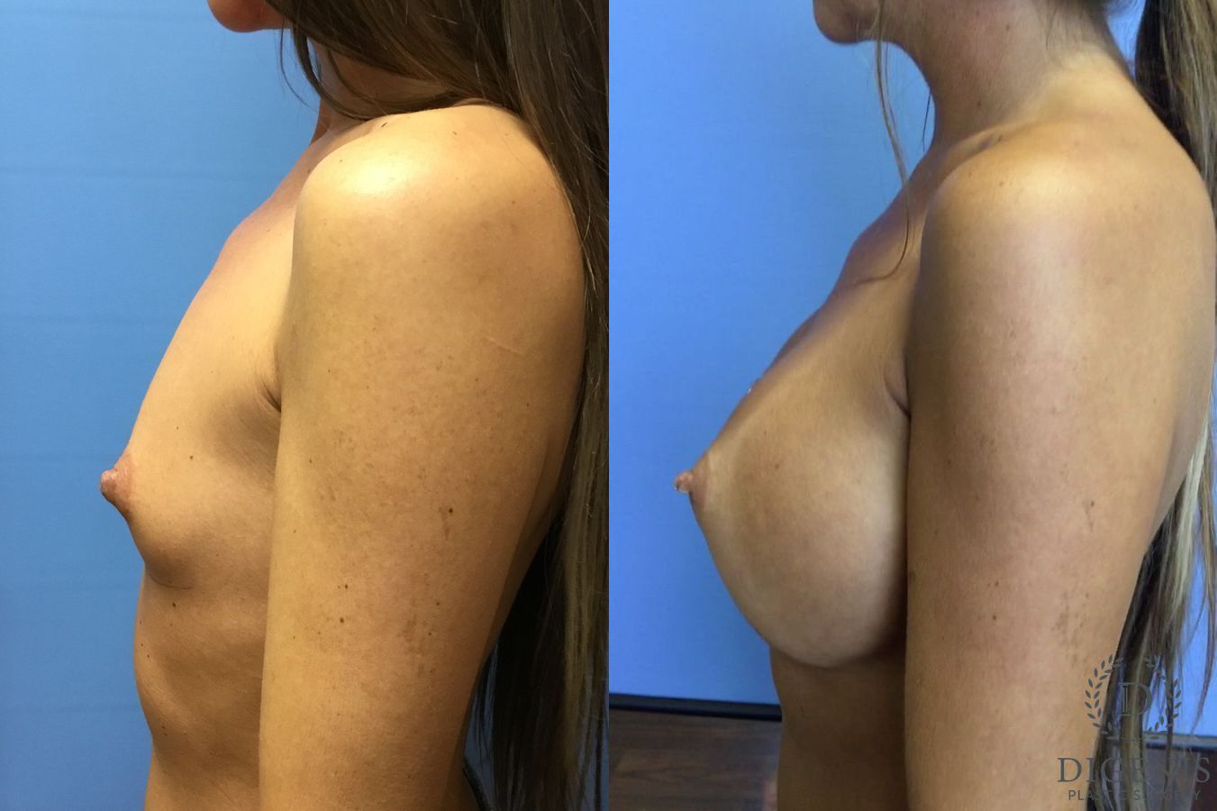 Before and after Breast Augmentation case 35110 - Angle 5